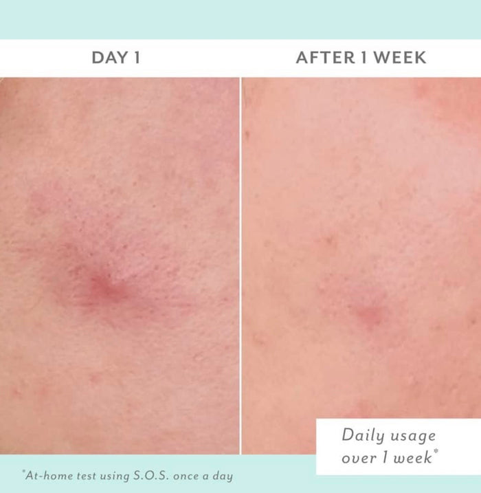 Patchology S.O.S Totally Invisible Clarifying Liquid Patch